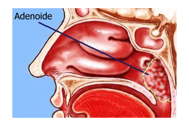 adenoide