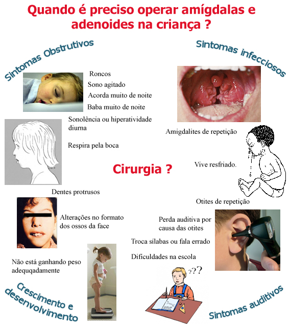 Quando Operar Amigdalas e Adenoide