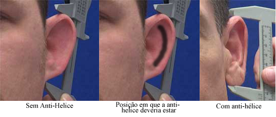 Otoplastia para Orelha de Abano