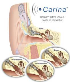 Carina - Aparelho Auditivo implantado com cirurgia